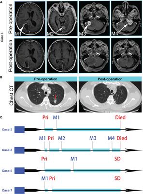 Heterogenous profiles between primary lung cancers and paired brain metastases reveal tumor evolution